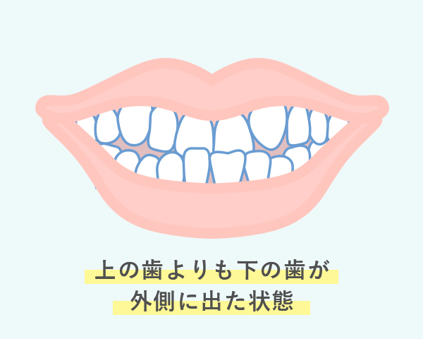 上の歯よりも下の歯が外側に出た状態